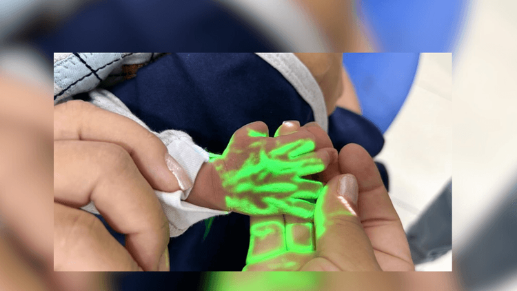 Aparelho localiza veias de recém-nascidos com projeção de luz na maternidade Mãe Luzia