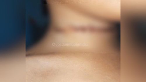 Horror: Criança é ferida no pescoço após ser atingida por linha de cerol, em Macapá