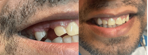 Cresce o número de pessoas que procuram implantes dentários no Amapá