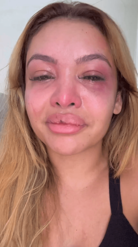 É preciso denunciar! Diz influenciadora agredida pelo ex-namorado 