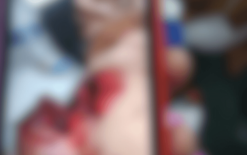 Estado Crítico: Criança que teve braço amputado em ataque de pitbull permanece na UTI